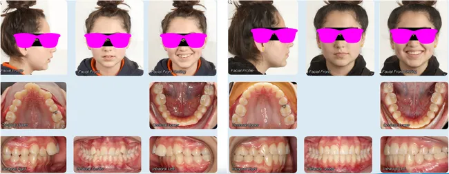 Case 1 - Before and after orthodontic treatment at Orthodontic Nations