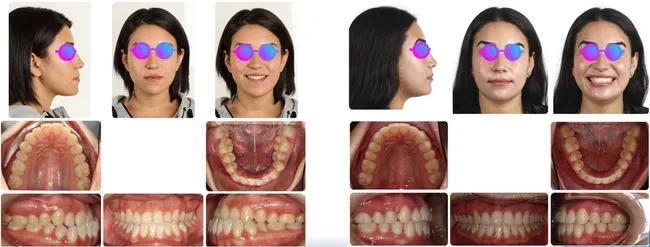 Case 3 - Before and after orthodontic treatment at Orthodontic Nations