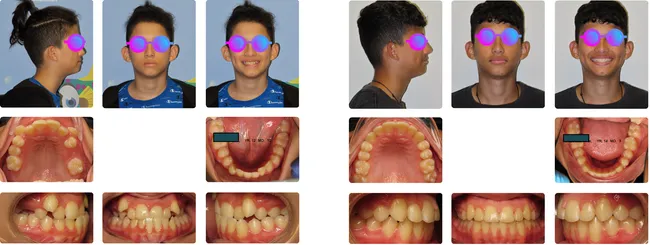 Case 5 - Before and after orthodontic treatment at Orthodontic Nations
