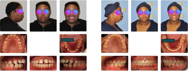 Case 7 - Before and after orthodontic treatment at Orthodontic Nations