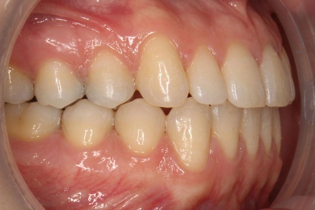 After TADs-assisted orthodontic treatment for an open bite, crossbite, and Class III bite concerns.