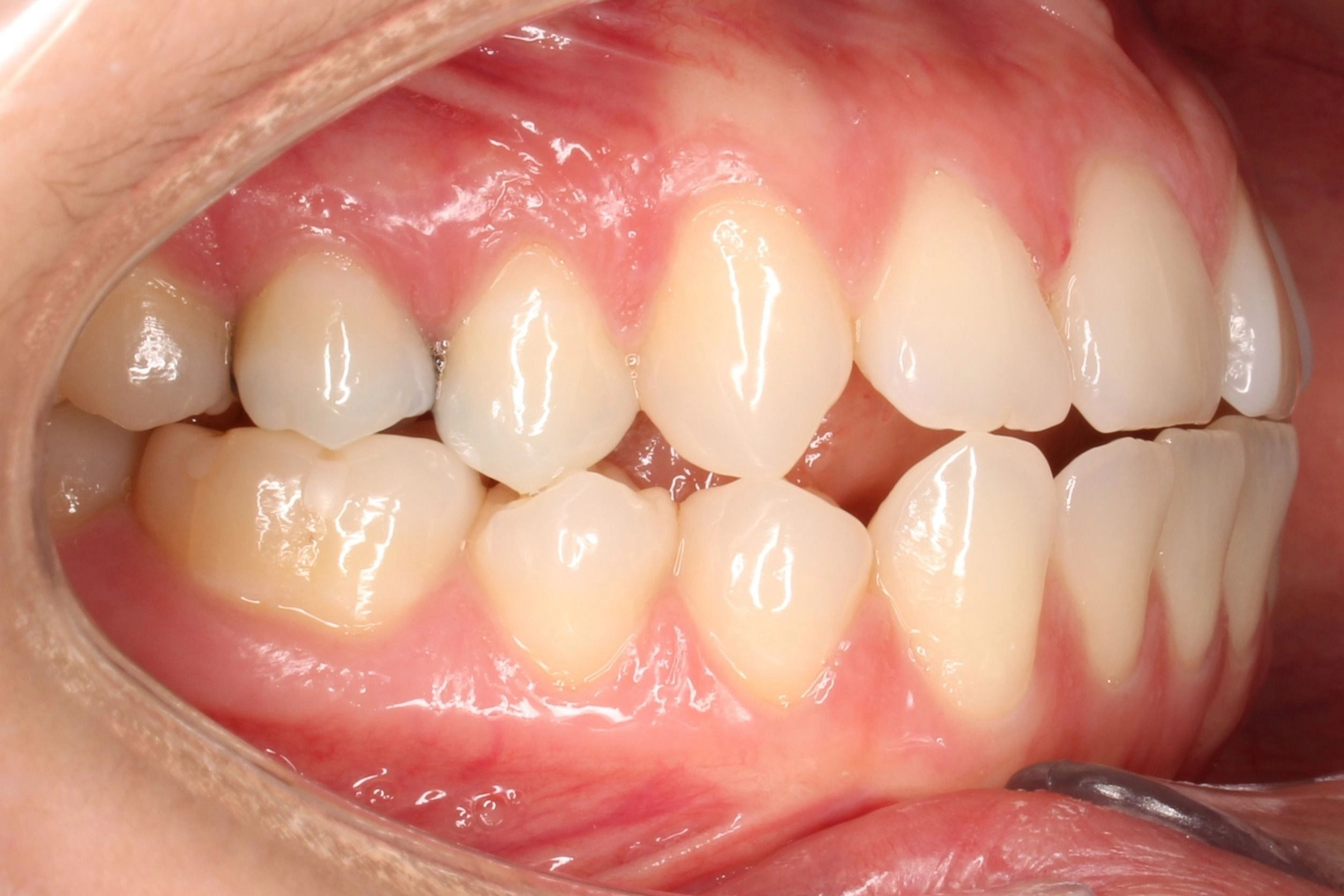 Before orthodontic treatment for an open bite, crossbite, and uneven lower dental midline.