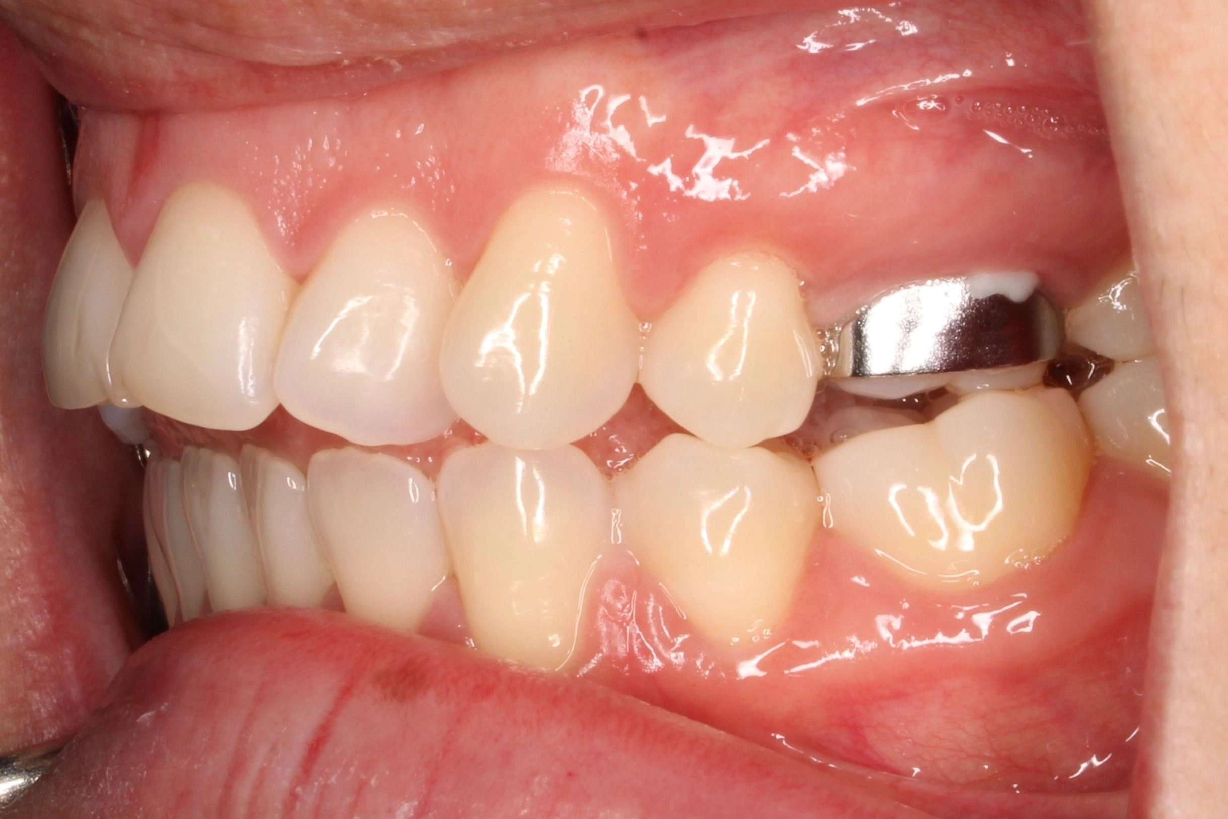 Before orthodontic treatment for an open bite, overjet, and crowded teeth.