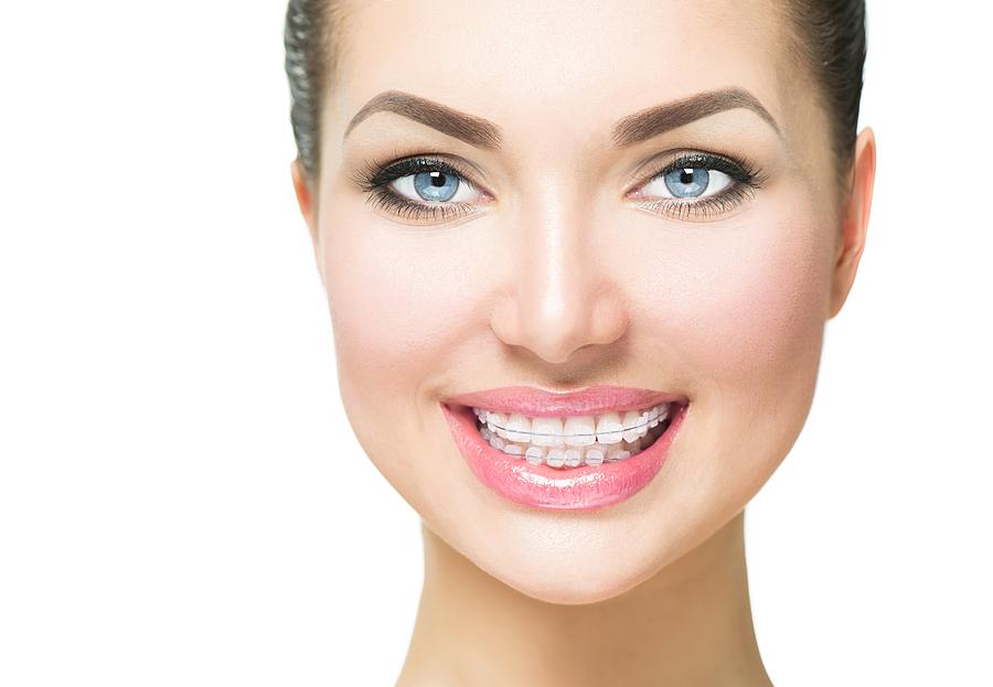 Achieving a Straighter Smile with Ceramic Braces: A Modern Orthodontic Solution