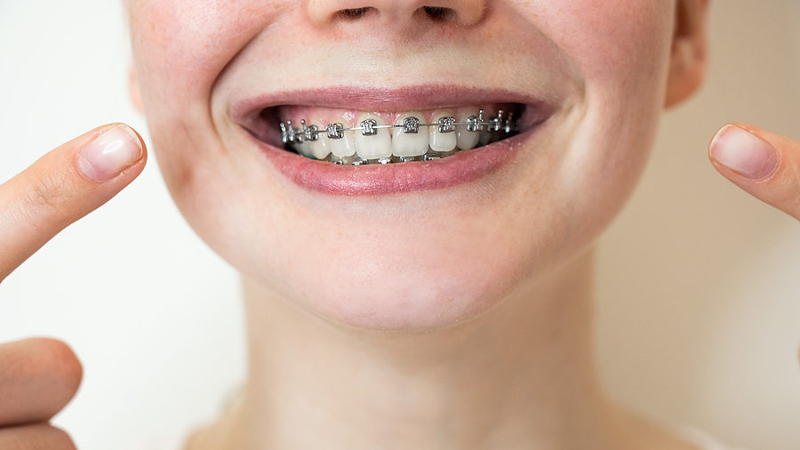 Achieve a Perfect Smile with Traditional Braces in The Woodlands, TX